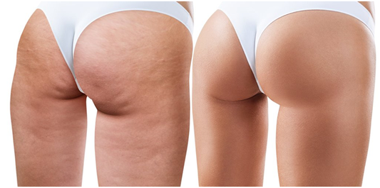 Anti-Cellulite Treatment