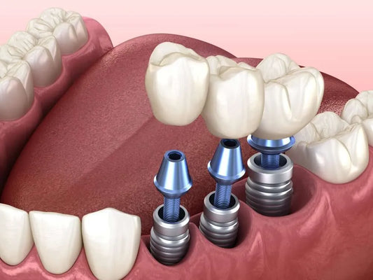 Turkey Dental Implants