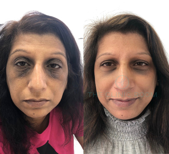 Dark circles before and after