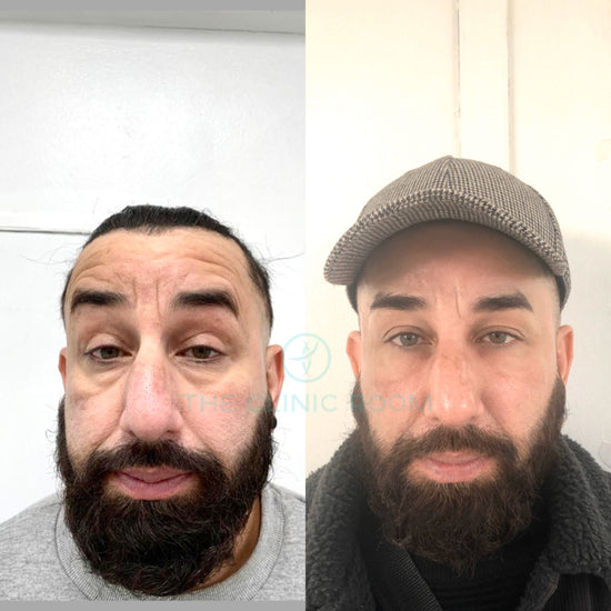 Eye bags before and after