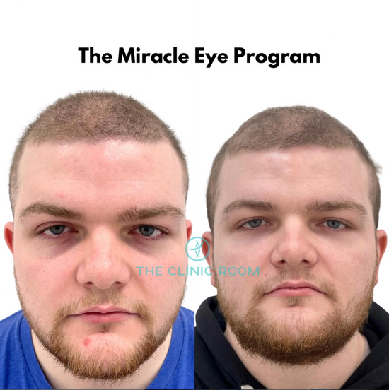 Lumi Eyes before and after