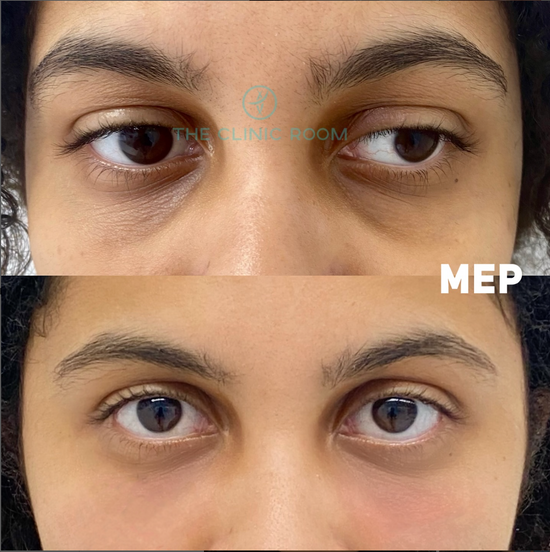 Lumi eyes in london