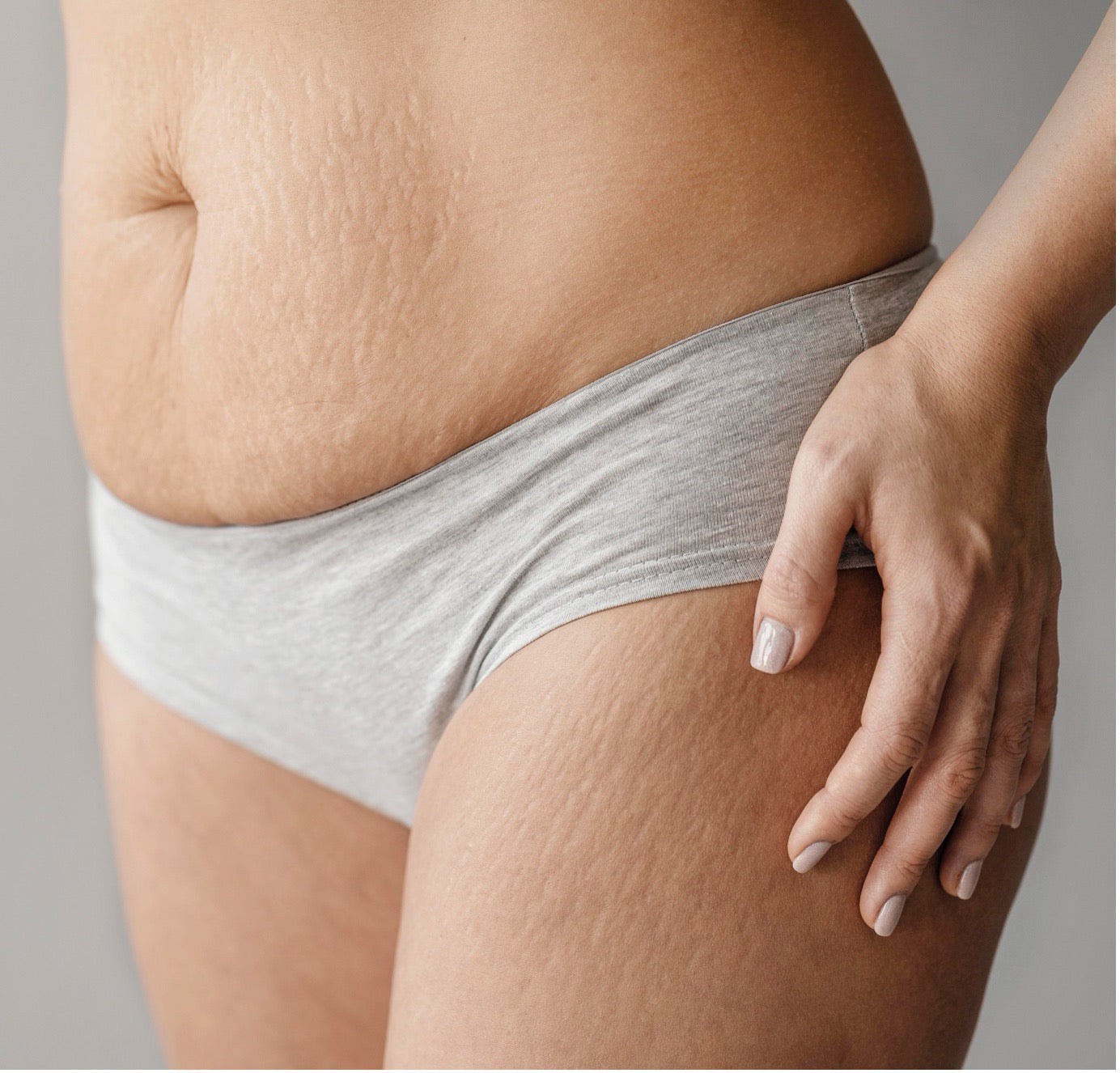 Stretch Mark Removal