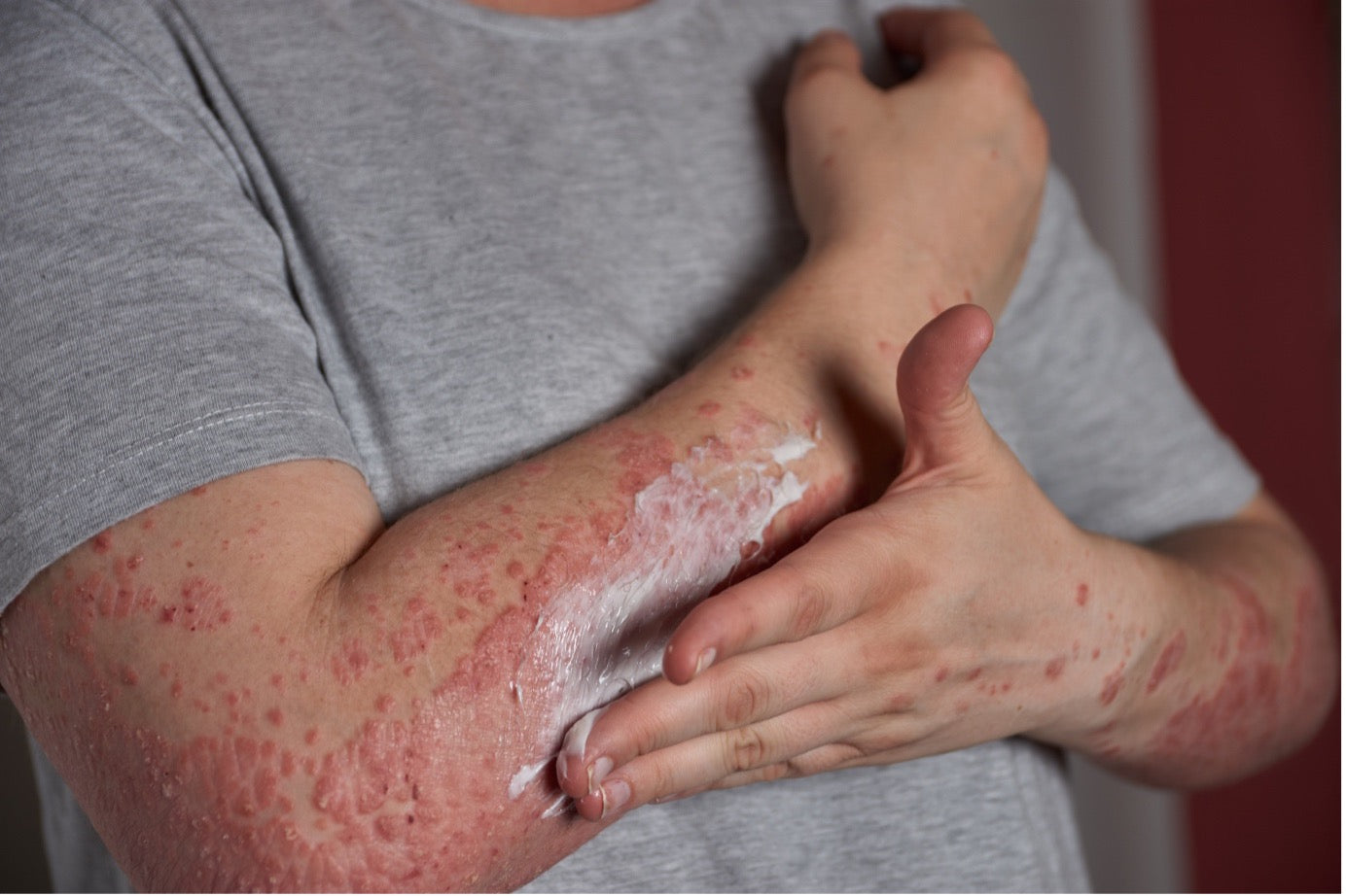 Eczema Treatment