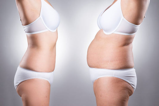 Liposuction Treatment