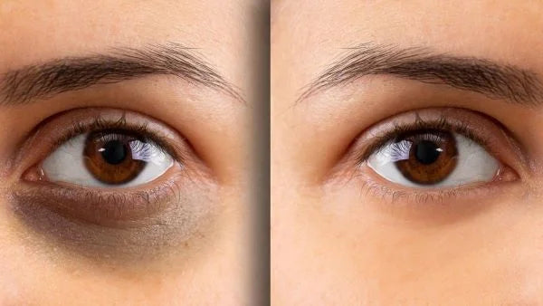 Lumi Eyes Treatment: Revolutionary Under Eye Rejuvenation