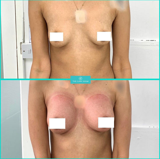 breast tenting Breast Lift | Treatments