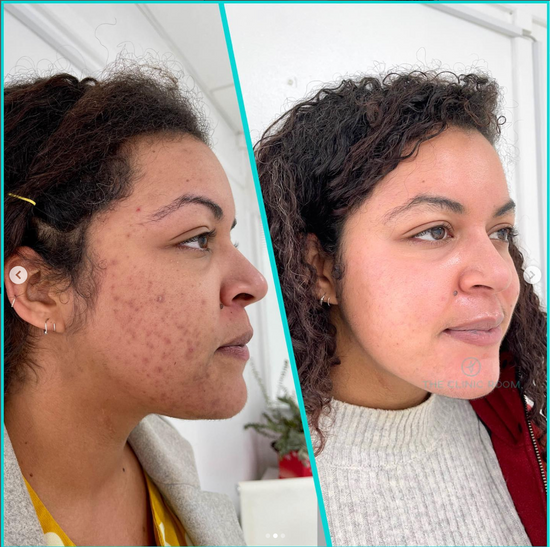 Miracle Skin Program before and after