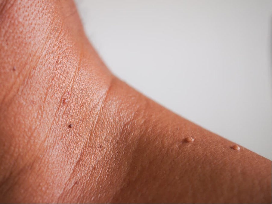Skin Tags / Milia Spot Removal